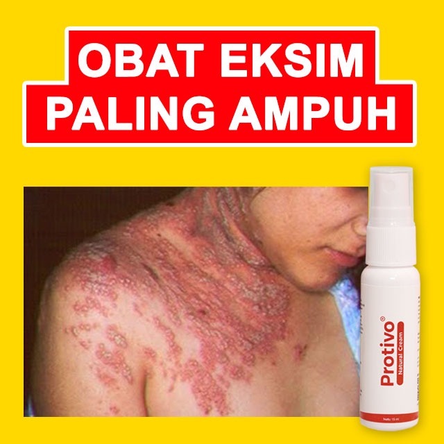 Obat Gatal Kulit | Obat Gatal Eksim | Obat Gatal Eksim Paling Ampuh | Obat Gatal Eksim Menahun | Oba