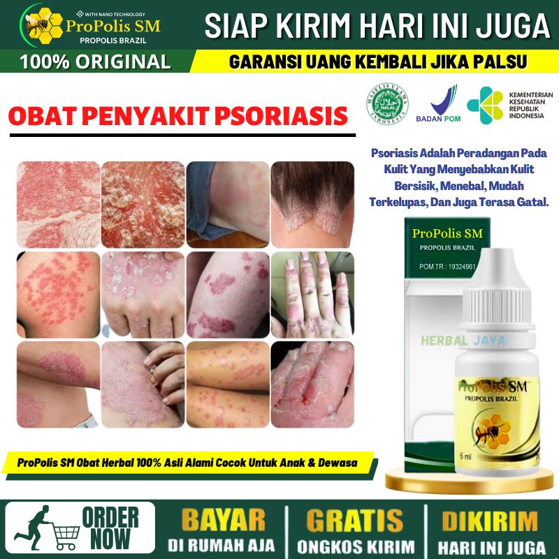 Obat Psoriasis Parah, Obat Psoriasis Penghilang Kulit Lumut 100% Herbal Alami, Obat Antibakteri Meng