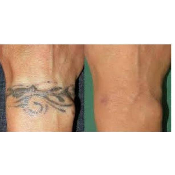 New(I41C)-✪) Obat Penghilang Tatto Permanen Xanuro-Z Original - Cream Tato Penghapus Sulam Alis Terl