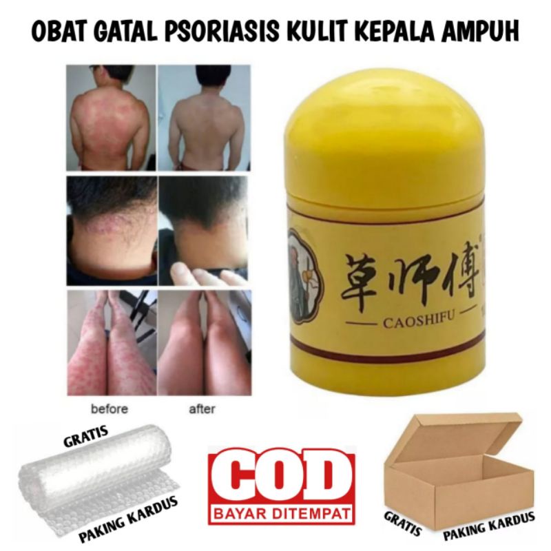 OBAT GATAL PSORIASIS KULIT KEPALA AMPUH OBAT PSORIASIS
