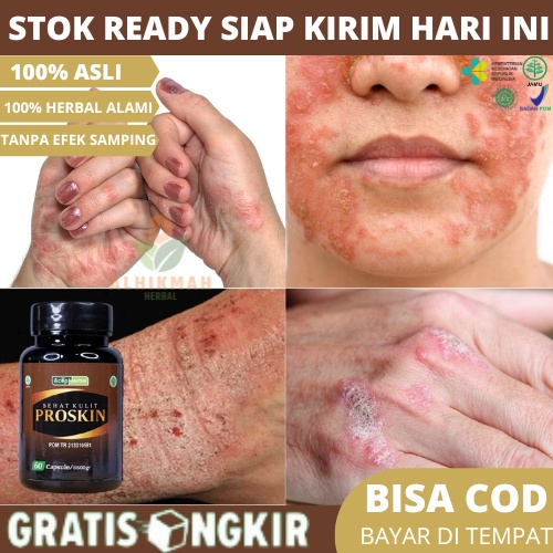Obat Eksim Menahun, Obat Eksim Basah dan Kering Menahun, Obat Kulit Gatal2 Eksim, Obat Gatal Kulit E