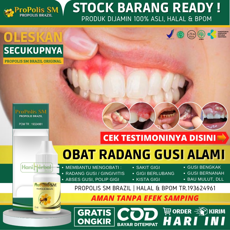 Obat Radang Gusi Alami Untuk Anak & Dewasa, Obat Radang Gusi / Gingivitis, Obat Gusi Bengkak dan Nye