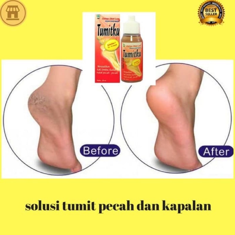 READY TUMITKU OBAT KAKI PECAH Original BPOM Solusi Kaki Pecah-pecah Dan Kapalan ukuran 30 ml