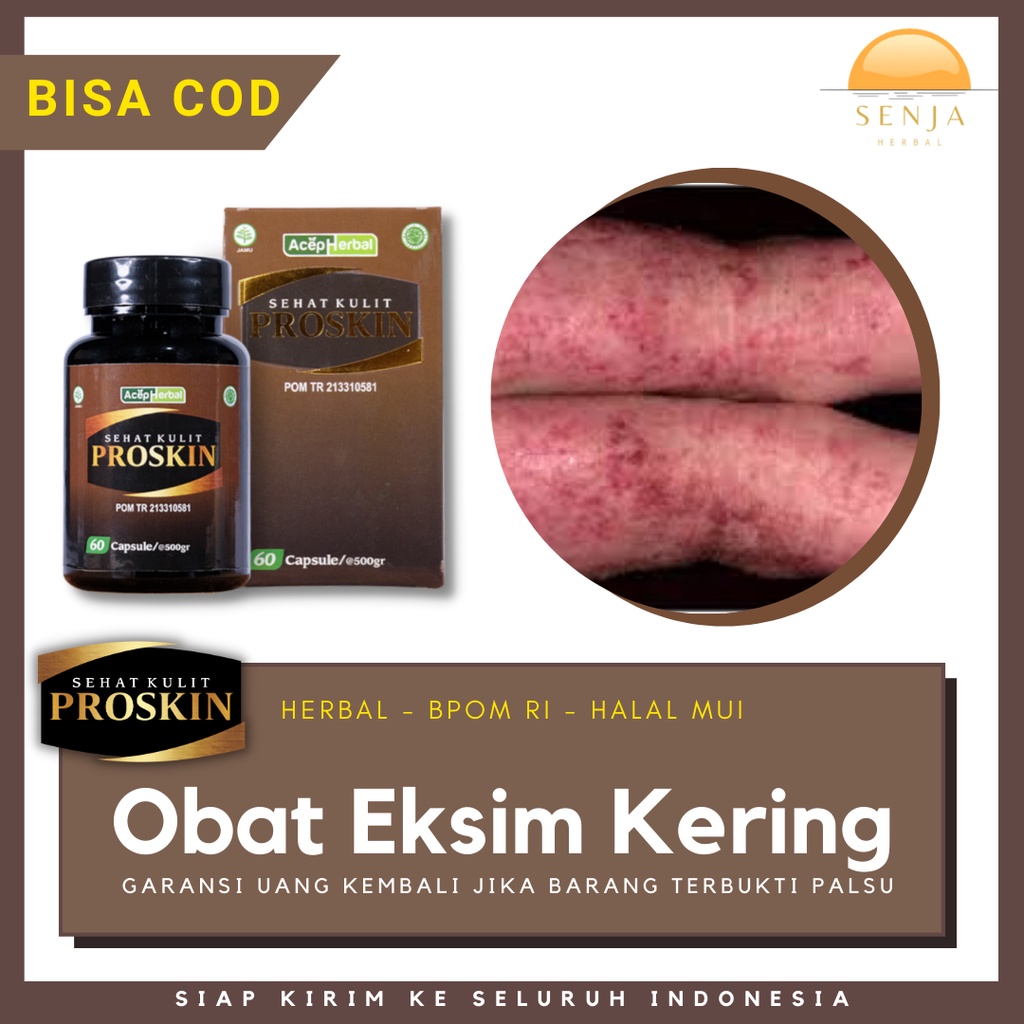 Obat Herbal Eksim Kering, Obat Gatal Eksim Kering, Obat Eksim Atopik, Obat Eksim Kering | PROSKIN