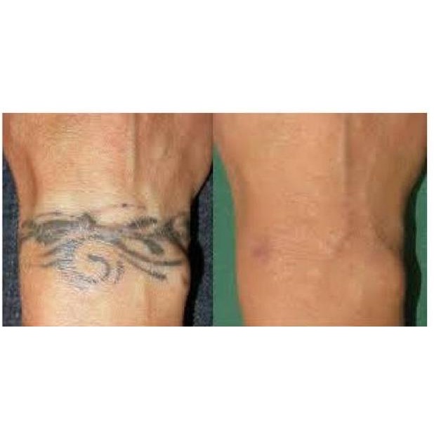 (E-X4X)(✪) Obat Penghilang Tatto Permanen Xanuro-Z Original - Cream Tato Penghapus Sulam Alis Terlar