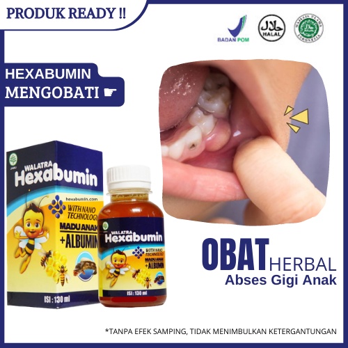 Obat Abses Gigi Anak, Benjolan Di Gigi Anak, Gusi Anak Bengkak Bernanah, Sakit Gusi Anak Kecil - Mad