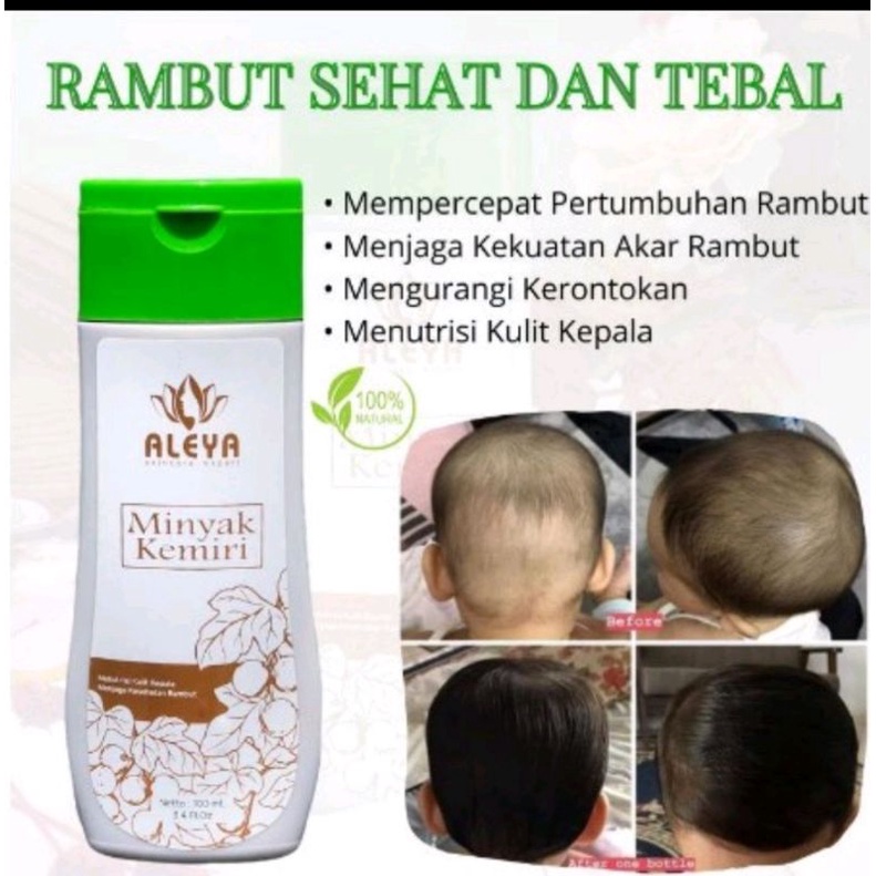 Minyak kemiri penumbuh rambut anti botak  obat kebotakan