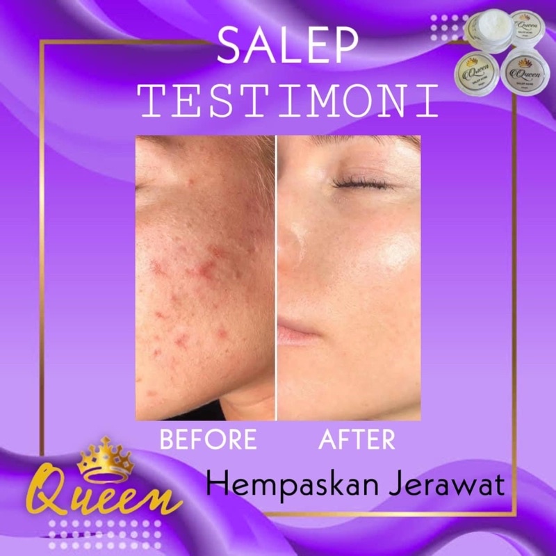 BISA (COD) QUEEN SALEP MAGIC FLEK DAN ACNE