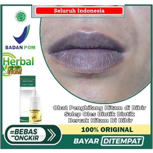 Obat Penghilang Hitam di Bibir, Salep Oles Bintik Bintik, Bercak Hitam Di Bibir, Bintik Hitam Di Bib