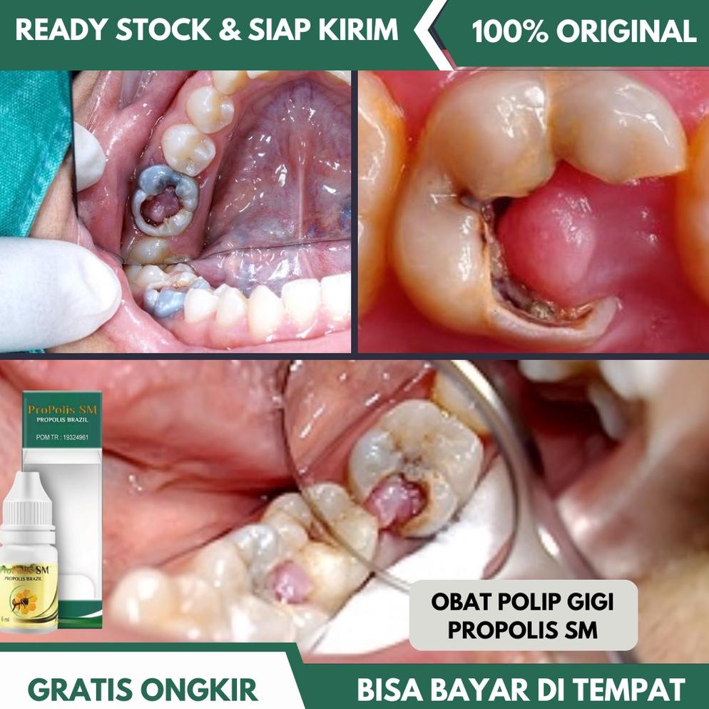 Obat Polip Gigi, Polip Pulpa Gigi, Sakit Gigi dan Gusi Bengkak Herbal - Propolis SM
