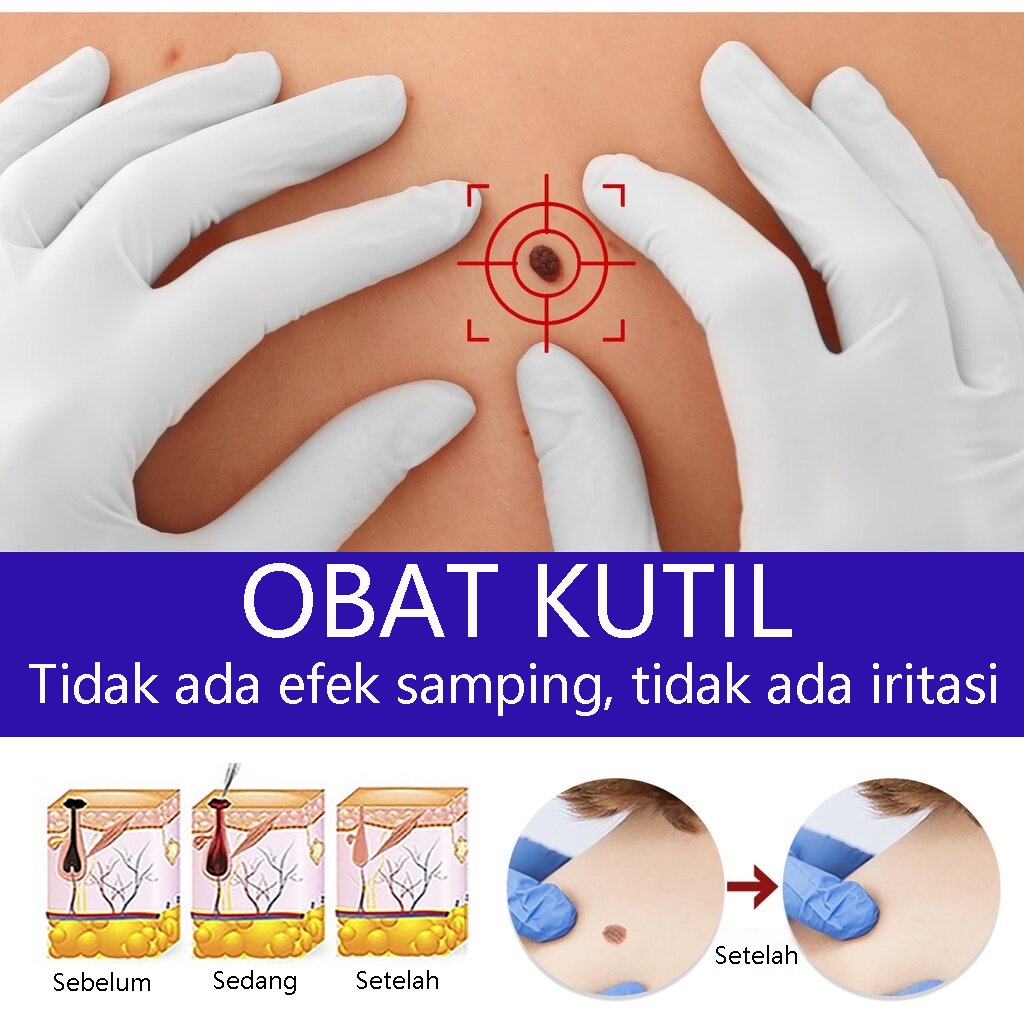 20G Obat Perontok Kutil, Obat Papiloma Penghilang Kutil,Obat Mata ikan,Kutil,Kapalan Wanita - Salep Kutil Kelamin - Obat Papiloma Di Leher, Repair And Clean Skin Tag Remover