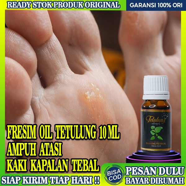 Obat Kapalan Kaki Tebal,Obat Tetes Kaki Rayapan Bau,Obat Mata Ikan,Kutil,Kapalan Fresim Oil 10ml,Oba