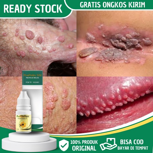Obat Kutil Kelamin, Kutil Kelamin Pria, Kutil Kelamin Wanita, Kutil Kelamin HPV, Salep Kutil Kelamin
