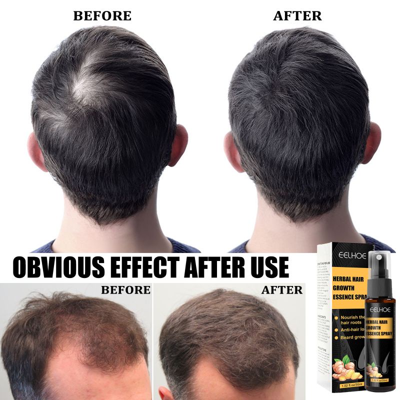 Eelhoe Herbal Hair Growth Essence Spray Penumbuh Rambut Rontok Botak anti hair loss aminexil Hair Tonic