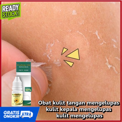 Obat kulit tangan mengelupas, kulit kepala mengelupas, kulit mengelupas, kulit wajah mengelupas, Her