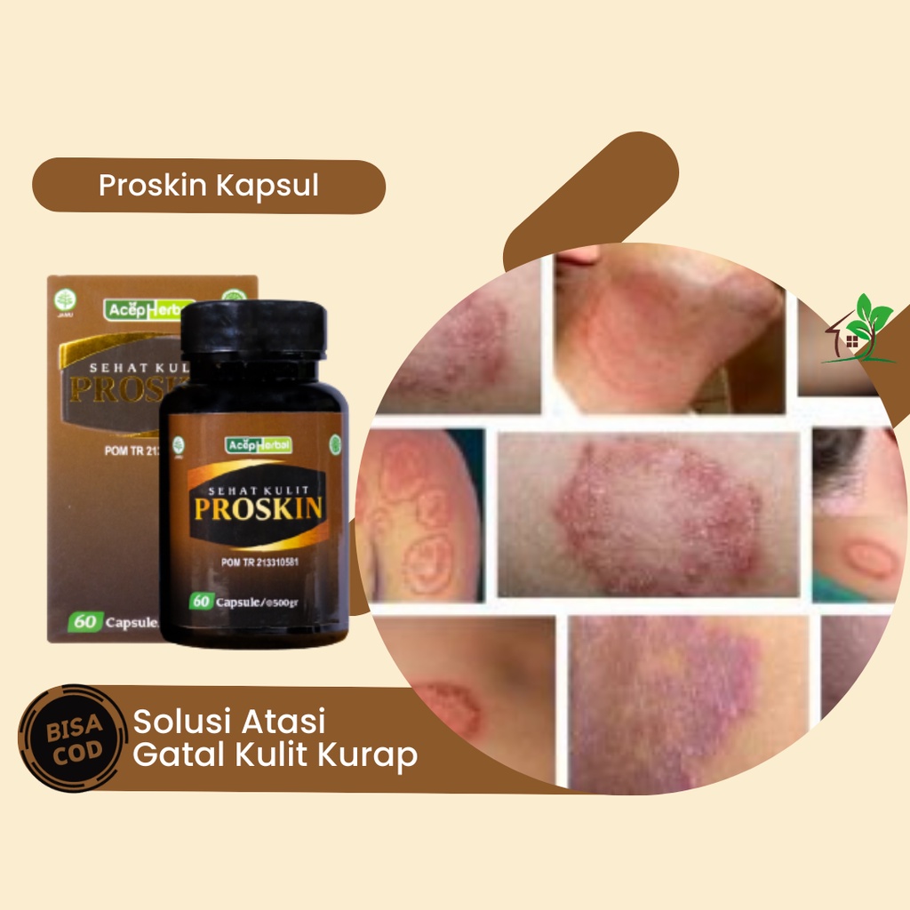 Obat Kurap, Obat Infeksi Jamur Kulit, Obat Penyakit Kulit, Obat Kudis Kurap, Obat Bercak Merah di Ku