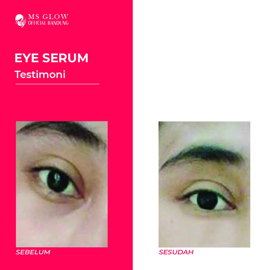 Eye Serum MS Glow / Penghilang Mata Panda Berkualitas Termurah By Msglowofficialbandung