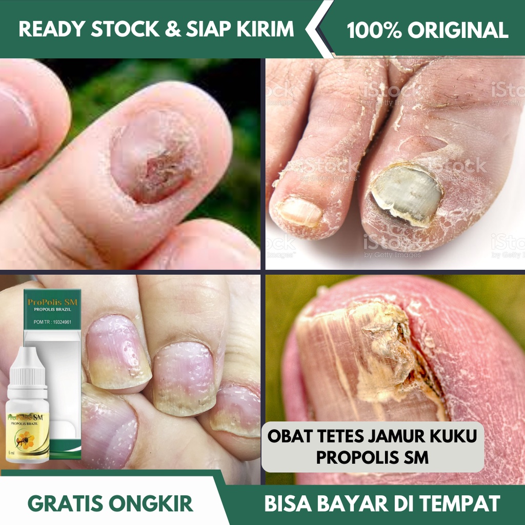 Jual Obat Jamur Kuku Cantengan Jempol Kuku Kaki Kuku Tangan Bengkak