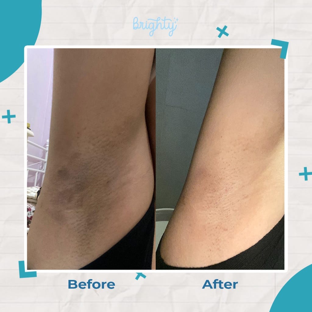 Brighty Glowing Underarm Pemutih Ketiak