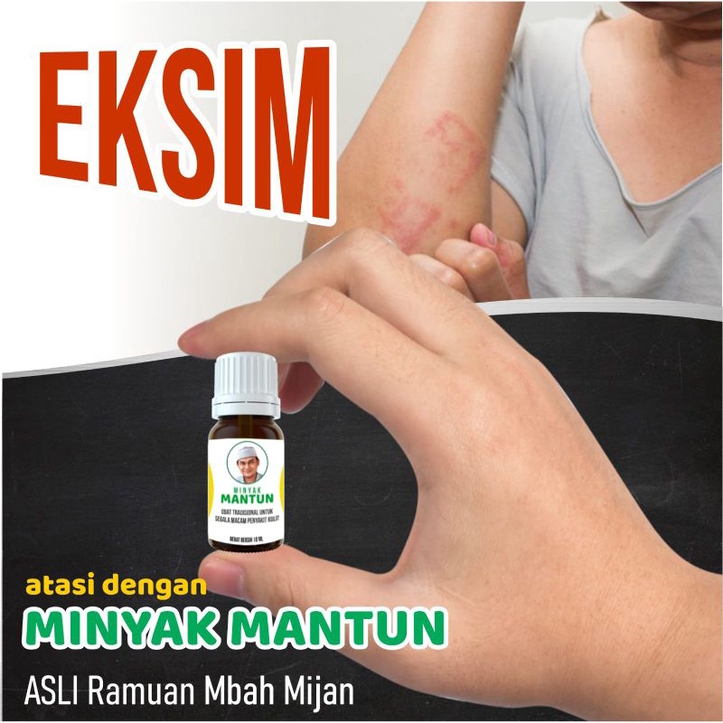 Minyak Mantun Herbal Penyakit Kulit