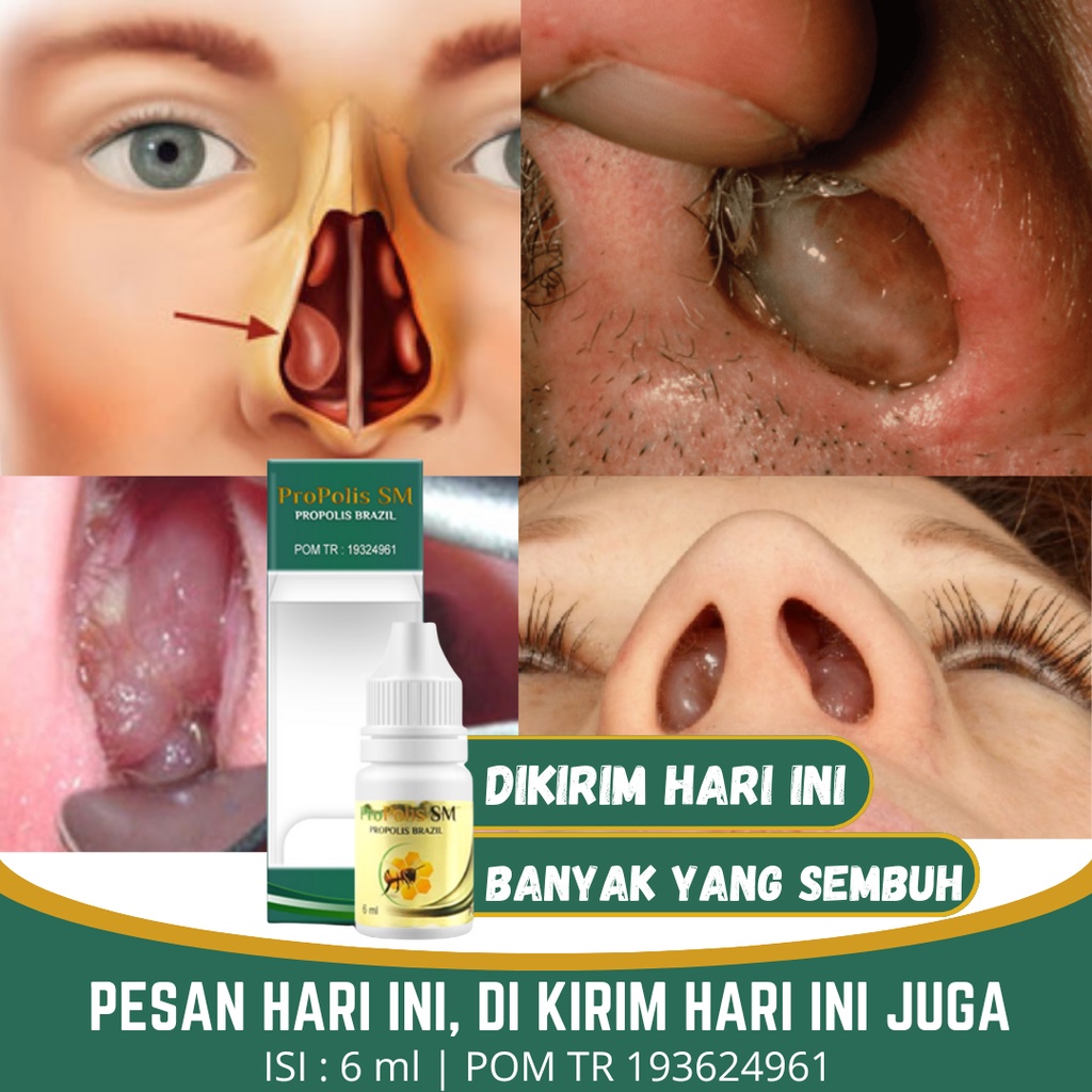 (Original) Obat Tetes Polip Hidung, Obat Hidung Bau Busuk, Sinusitis, Penghancur Polip Hidung, Obat