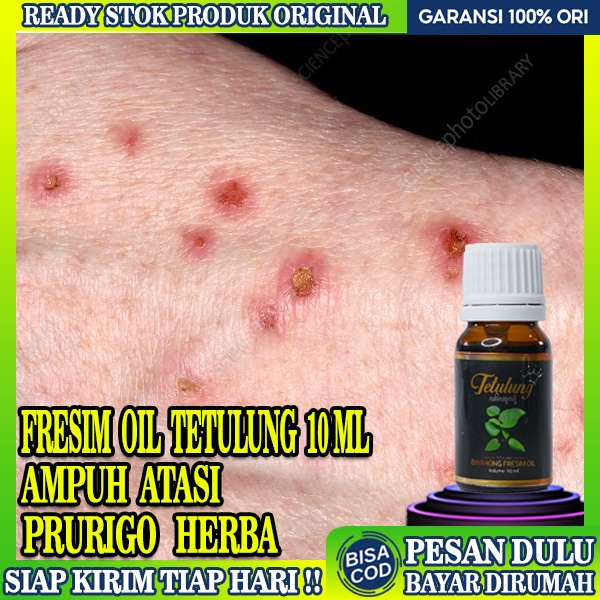 Jual Obat Darah Manis Prurigo Obat Budug Seluruh Badan Obat Prurigo