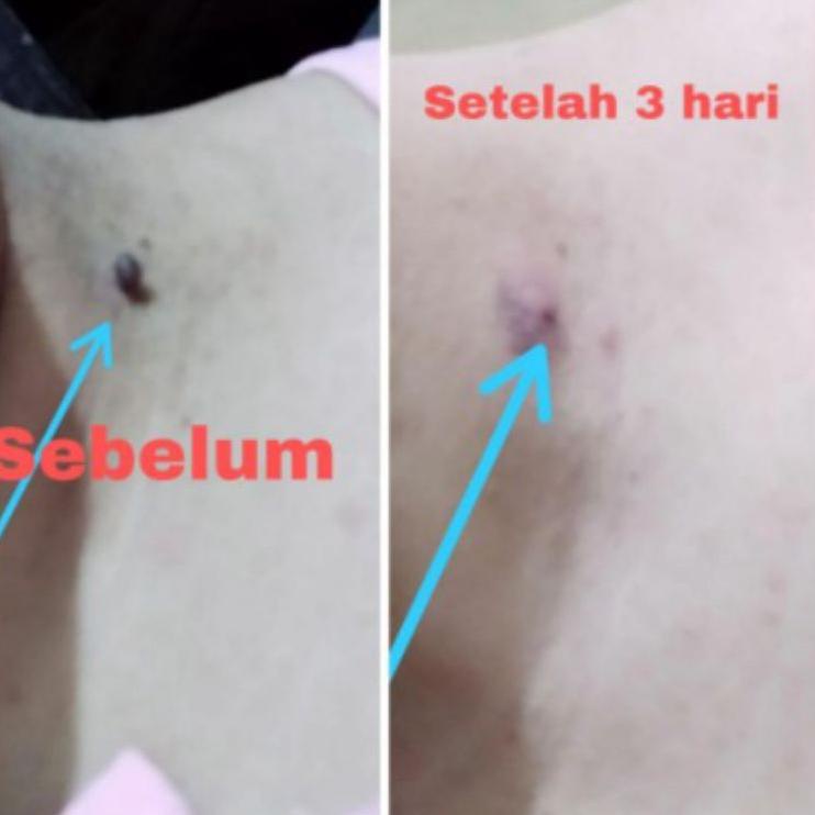 KWER-66 Kutil TCA 80% Super Sale