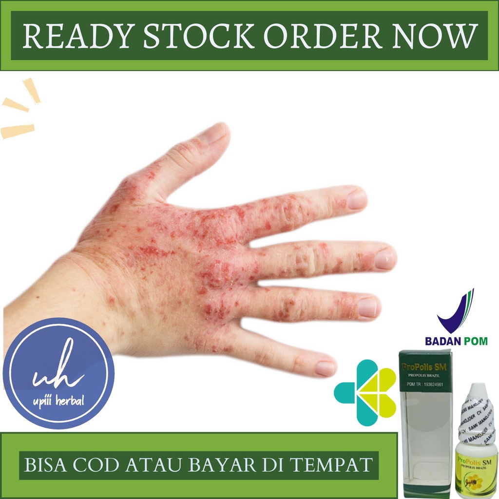 Obat Alergi Detergen, Obat Untuk Alergi Detergen, Obat Eczema, Obat Dermatitis, Obat Eksim Dishidrot