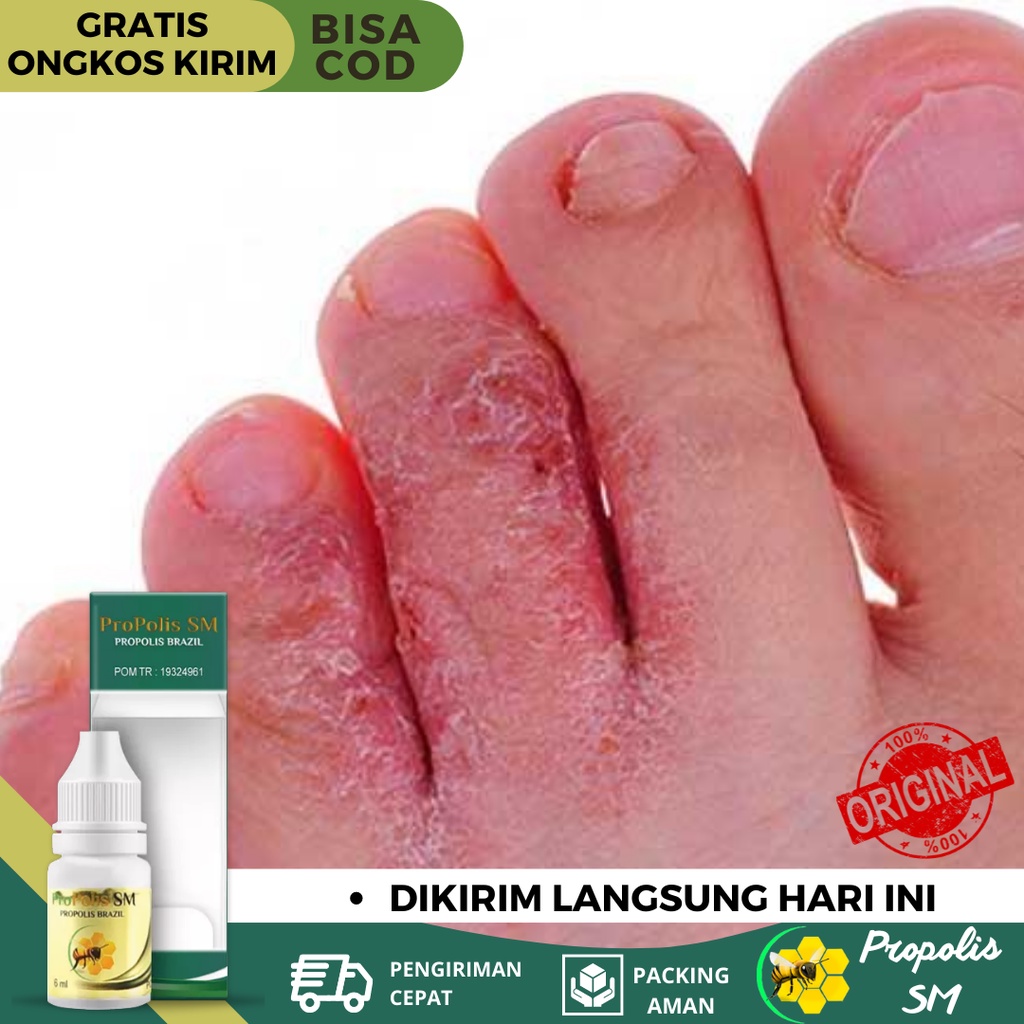 Obat Kutu Air, Obat Kutu Air di Kaki, Obat Kutu Air Di Sela Jari Kaki, Obat Gatal Kutu Air, Obat kut