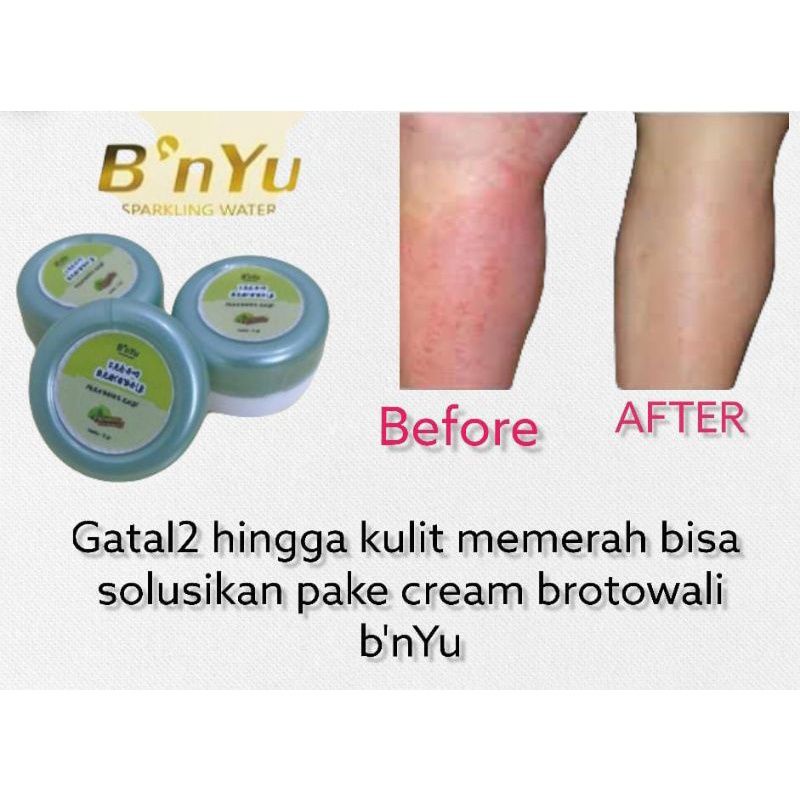 B'NYU CREAM BROTOWALI | TOTOL JERAWAT | SALEP BUAT GATAL, PANU, KADAS, KURAP, KUTU AIR, KUDIS, LUKA BAKAR
