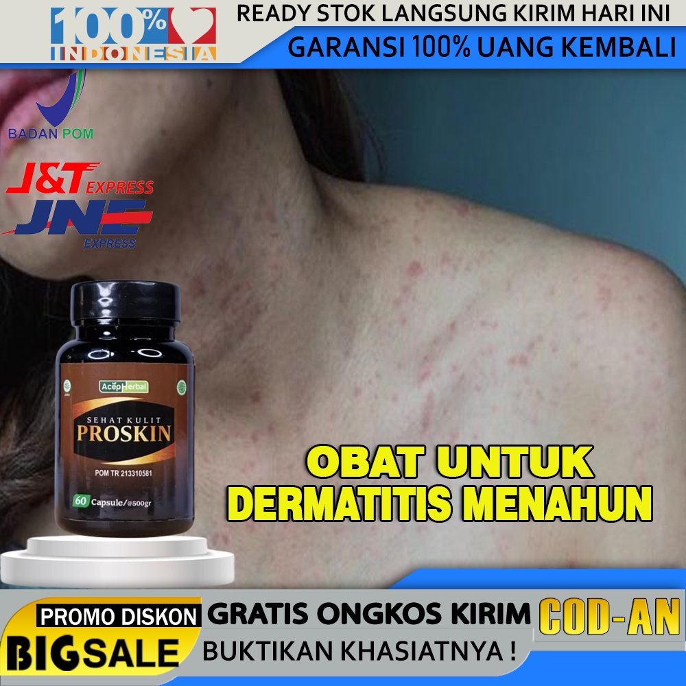 Obat Dermatitis Atopik