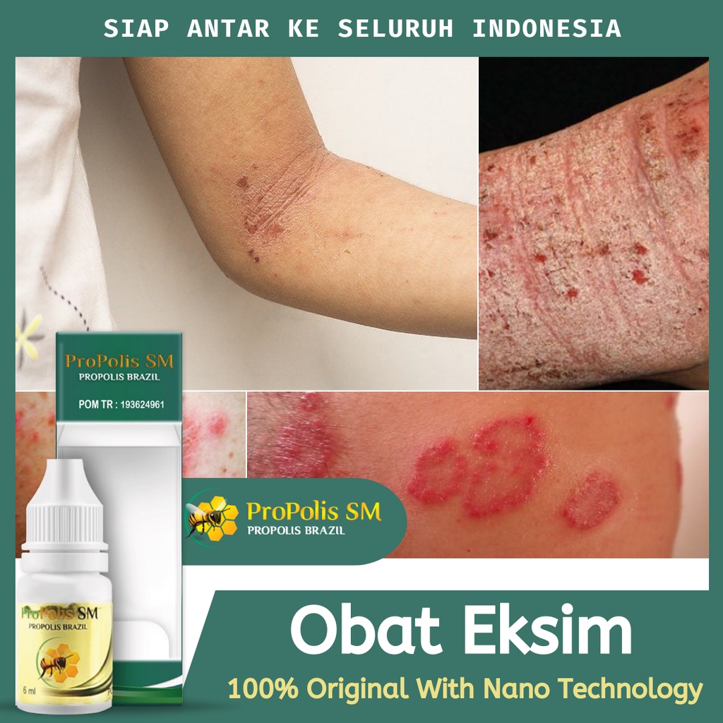 PROPOLIS SM Obat Pereda Gatal Eksim, Obat Atasi Eksim, Obat Herbal Eksim, Obat Hilangkan Luka Eksim