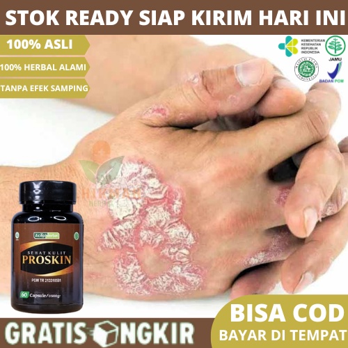 Obat Gatal Psioriasis, Obat Gatal Bersisik, Obat Gatal Kulit Kering, Obat Kulit Kepala Gatal, Obat G
