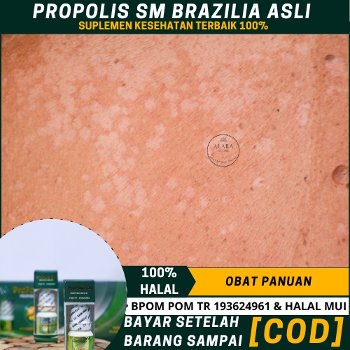 Obat Hapur Kulit, Hapuran Di Punggung, Wajah, Tangan, Obat Hapur Anak&Dewasa, Penghilang Hapur, Panu