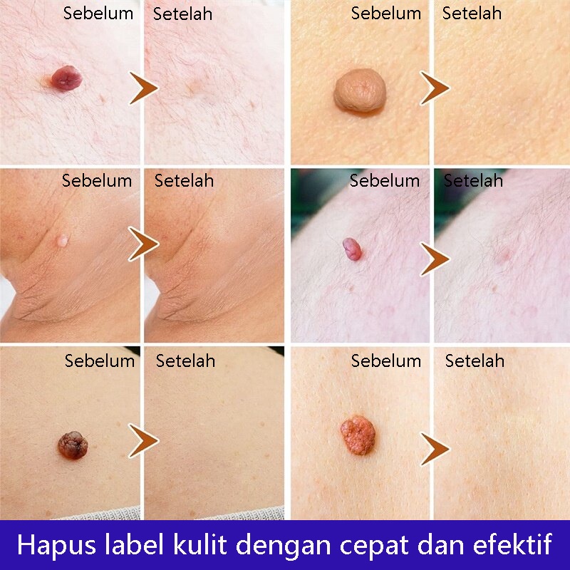 20G Obat Perontok Kutil, Obat Papiloma Penghilang Kutil,Obat Mata ikan,Kutil,Kapalan Wanita - Salep Kutil Kelamin - Obat Papiloma Di Leher, Repair And Clean Skin Tag Remover