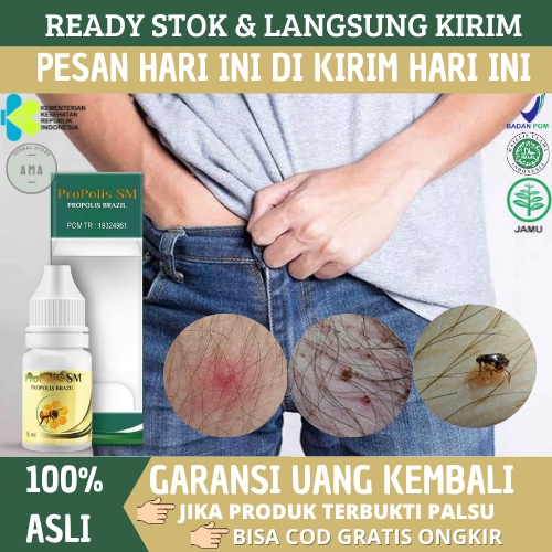 Propolis SM - Obat Gatal Tungau di Kemaluan, Bentol Di Kelamin, Gatal Bulu Rambut Kemaluan, Gatal Bu
