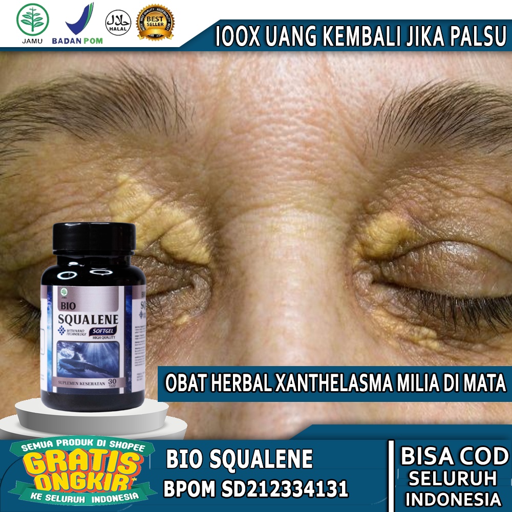 Jual Obat Xanthelasma, Gumpalan Lemak Di Kelopak Mata, Obat Penghilang