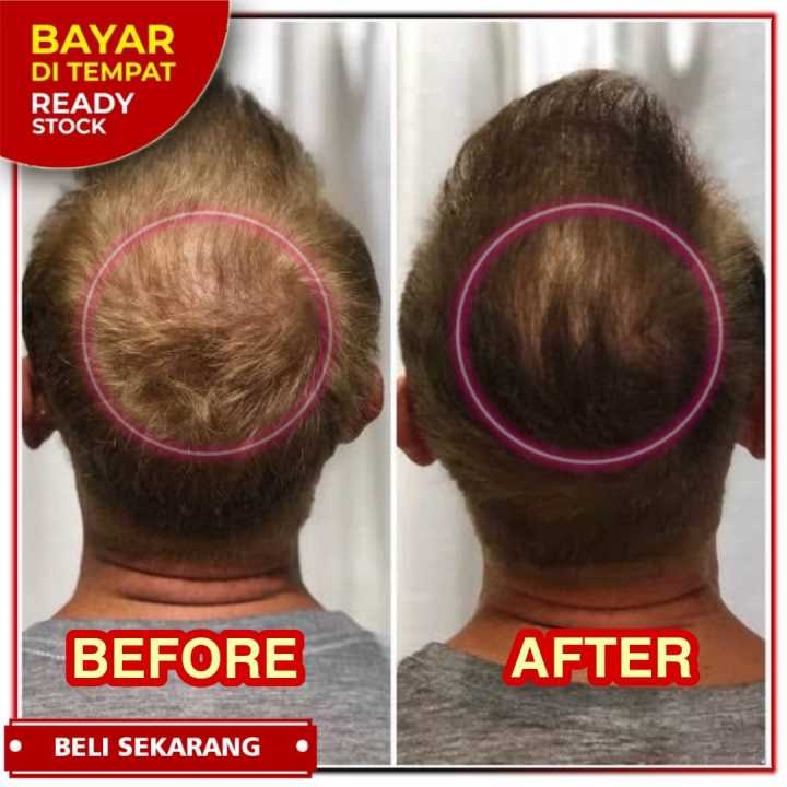 Penumbuh Rambut Pitak Secara Cepat Hair Tonic Penumbuh Rambut Botak Cepat Penumbuh Rambut Secara Cep