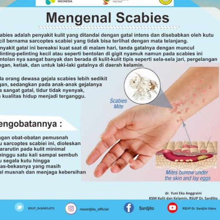 (U[2T]♥) salep krim obat scabies manusia, gatal pesantren, gatal karena tungau / kutu, gudik premium