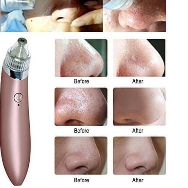 ➬ ALAT PENYEDOT KOMEDO DAN JERAWAT BEAUTY SKIN CARE CW - 666 ⟳
