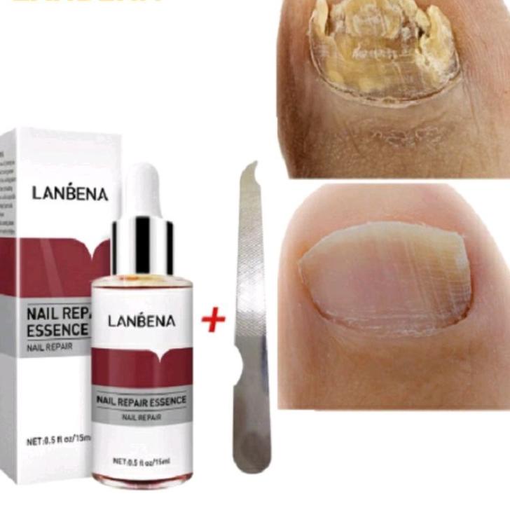 Harga Max--PENGHILANG JAMUR KUKU LANBENA SERUM