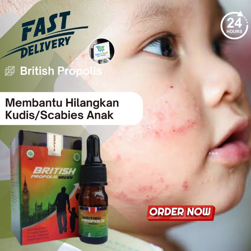 British Propolis 6ml Kudis Anak Gatal Gatal Kulit Selangkangan Eksim dan Jamur Paling Ampuh Alergi S
