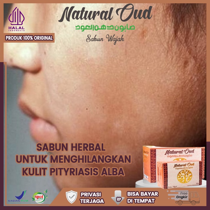Sabun untuk Pityriasis Alba
