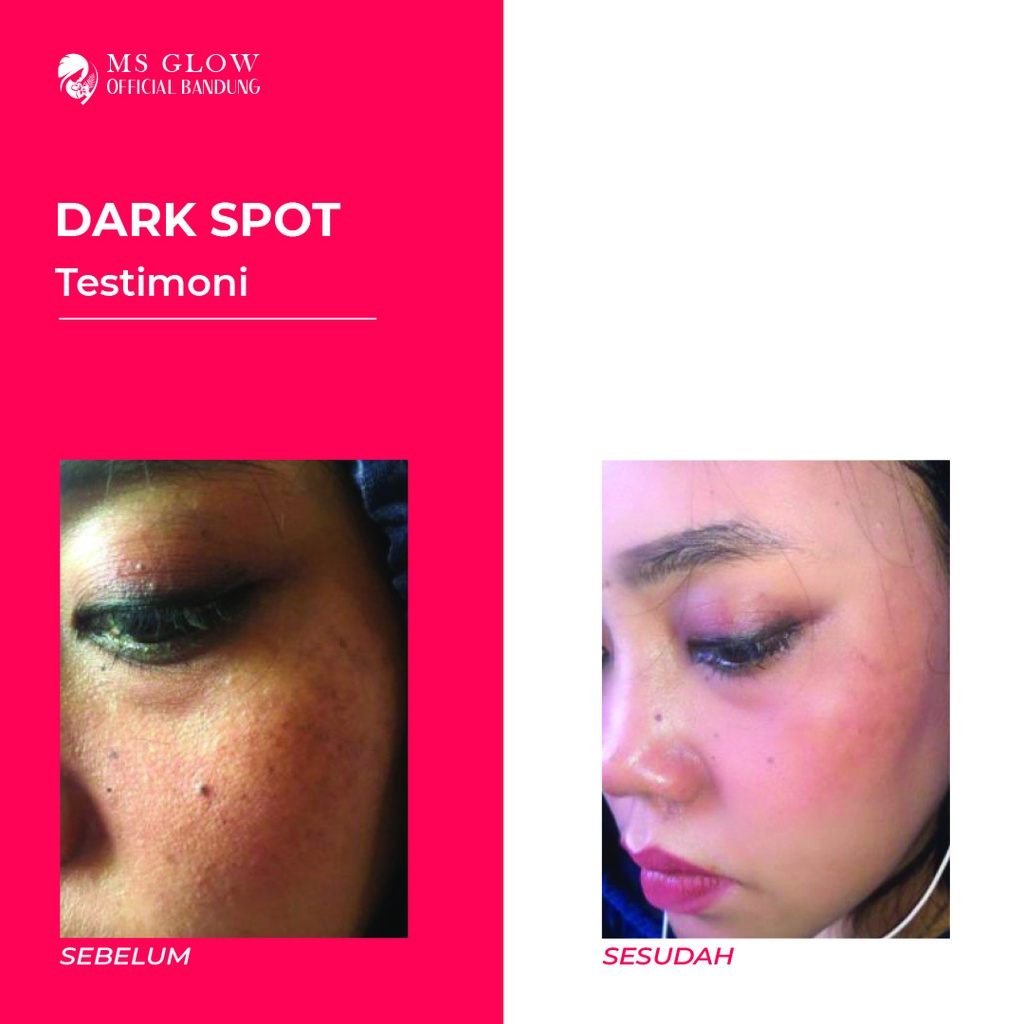Ms Glow Dark Spot Original Serum Wajah Penghilang Flek Hitam - By ms.glowofficialbandung