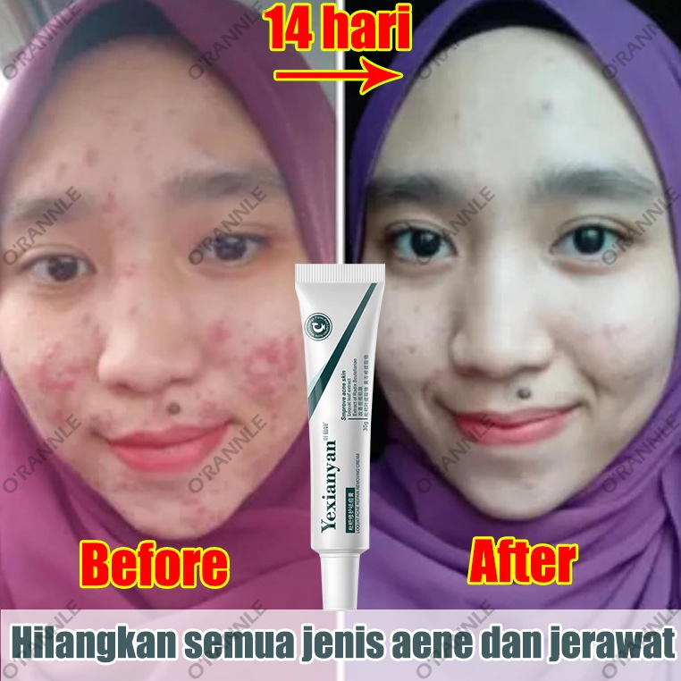 【ORANNLE】[100% Asli] Cream jerawat obat totol jerawat krim jerawat obat jerawat dan bekas jerawat Jerawat Removal of Acne Cream Untuk Pria dan Wanita