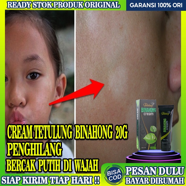 Obat Bercak Putih Di Badan,Obat Salep Vitiligo Bercak Putih,Obat Vitiligo Obat Bercak Putih Di Tubuh