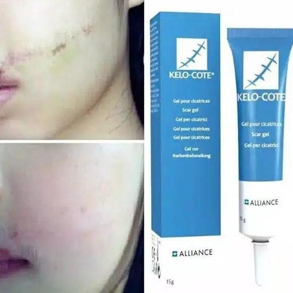 SUNTIK KELOID AMPUH SALEP OBAT KELOID SUDAH BERTAHUN TAHUN