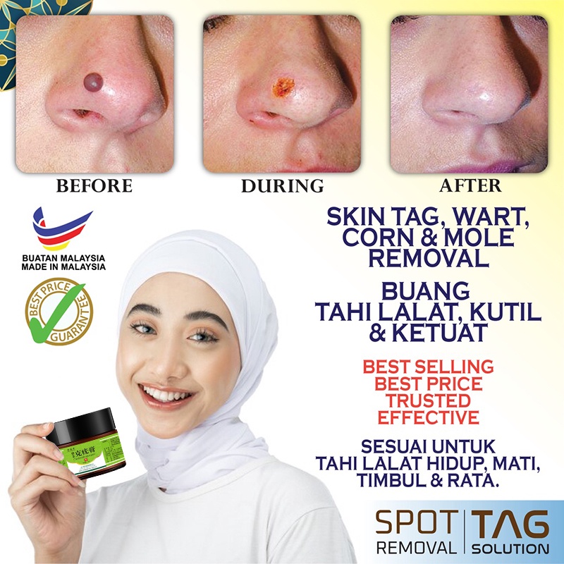 Salep kutil Obat kutil Obat tahi lalat Salep tahi lalat Obat kutil di leher | penghilang papiloma wajah | perontok kutil muka jari kaki | Obat Kutil Di Tangan Kaki Wajah Benjolan Besar Dan Kecil Daging Tumbuh