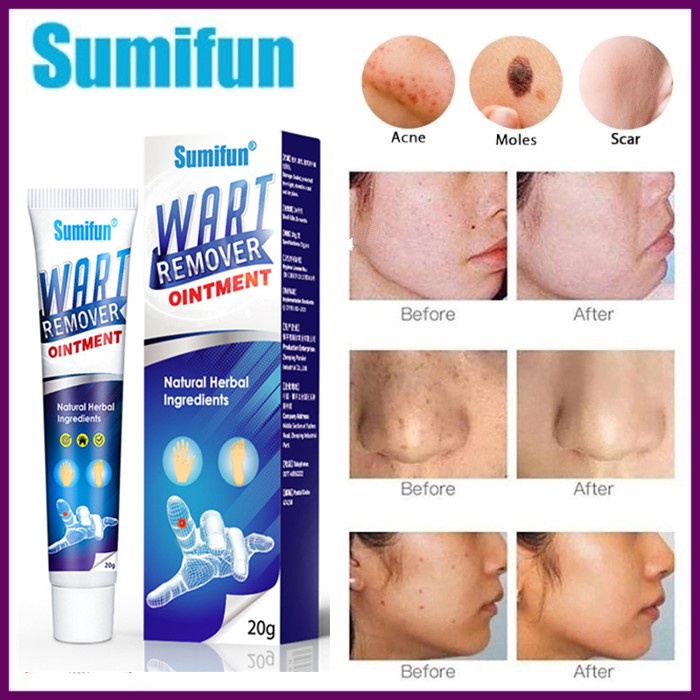 Skin Tag Remover Menghilangkan Kutil Tahi Lalat Mata Ikan Wart Remover Ointment 20G