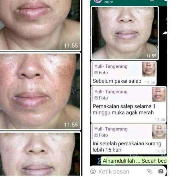 [X-4-Y ✪] Salep flek bandel liz skincare / flek hitam / cream flek / salep flek membandel-pasti diki